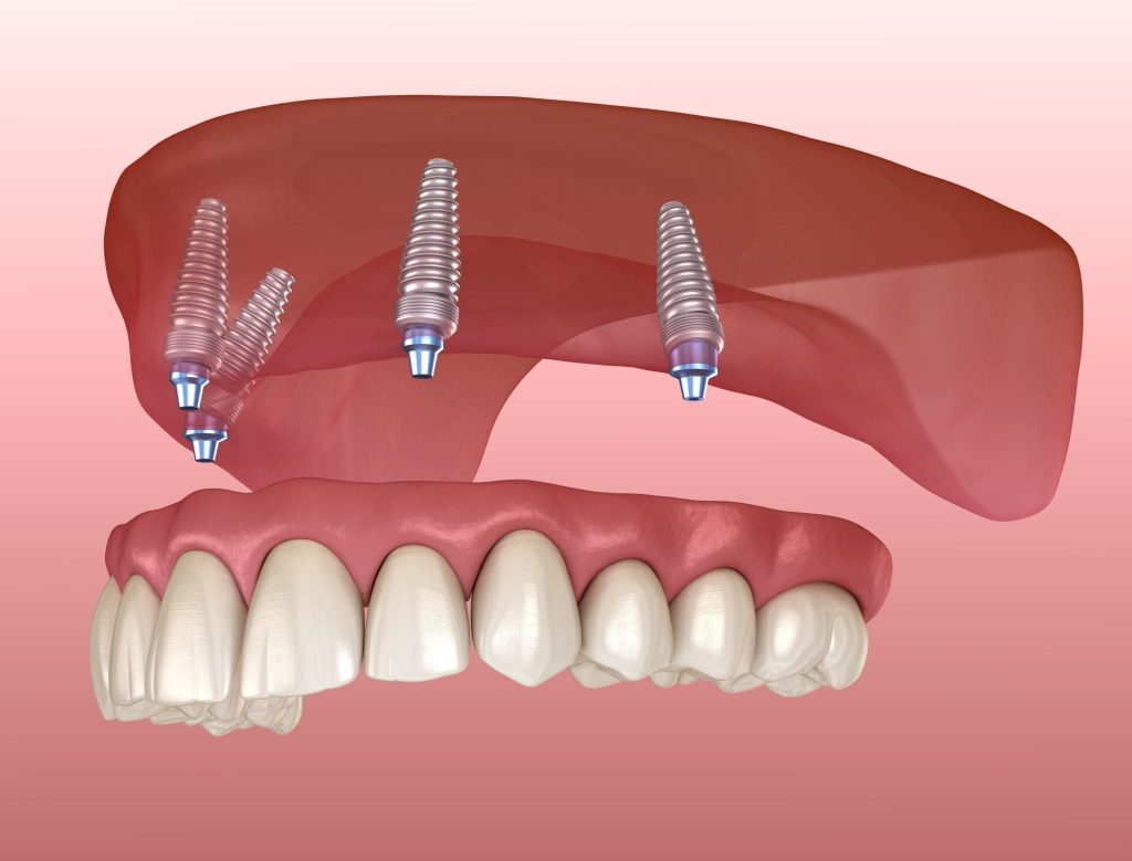 Why Dental Implants Are the Best Solution for Missing Teeth in Sydney